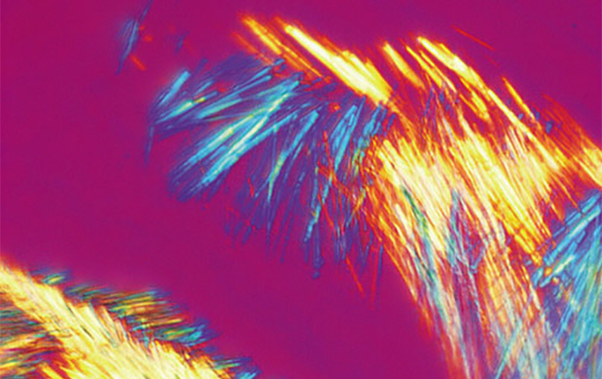 简单的痛风检查 简单的痛风检查